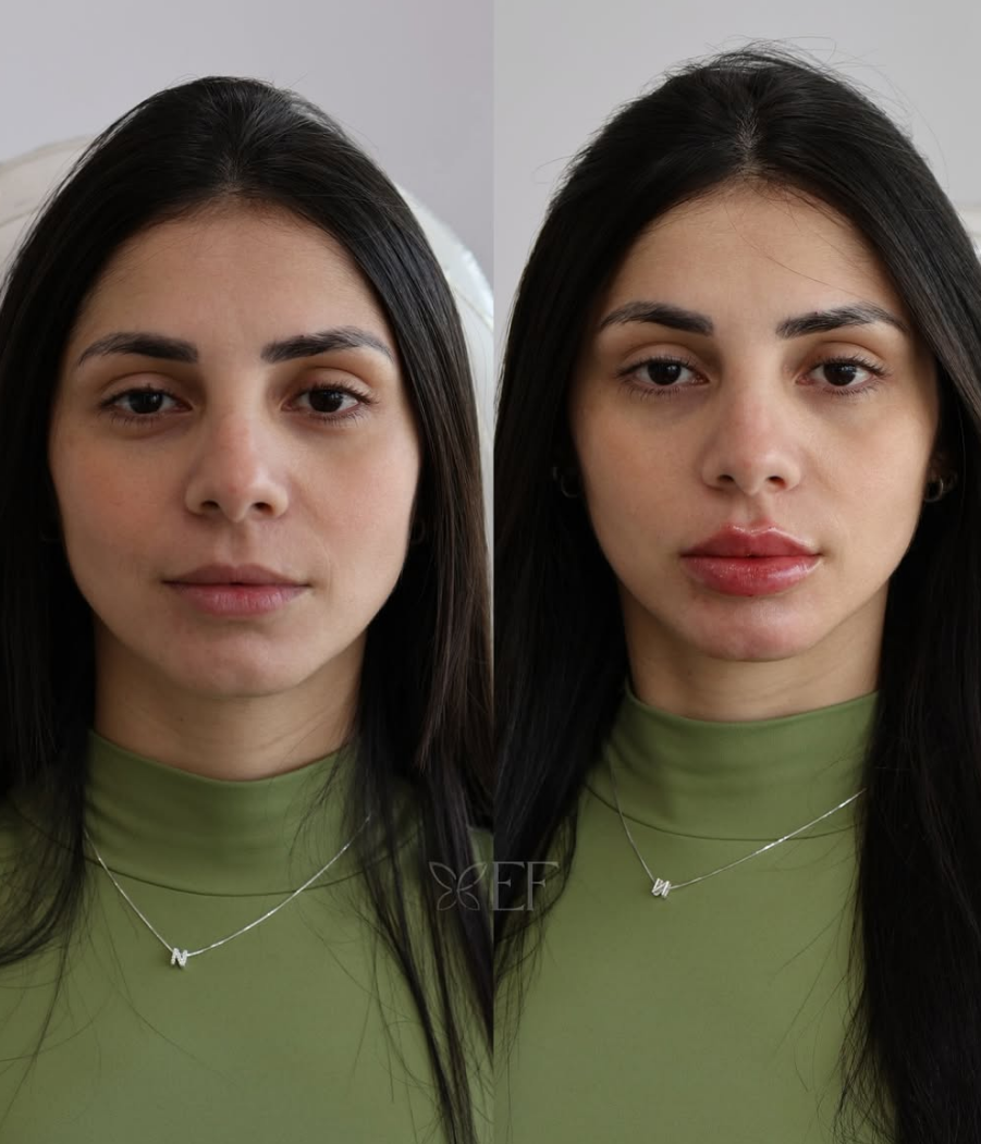 Antes e depois — Preenchimento Labial